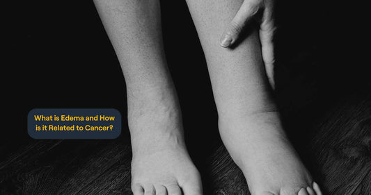 What is Edema and How is it Related to Cancer?